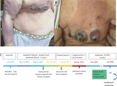 Case report: Zanubrutinib-induced dermatological toxicities: A single-center experience and review